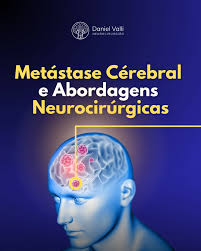 🧠 Metástase Cerebral : Quando a Cirurgia é Indicada? A Metástase Cerebral  ocorre quando tumores de outras partes do corpo se espalham para o cérebro,  trazendo desafios importantes no tratamento. A cirurgia