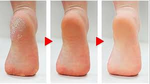 Calo Seco No Dedo Do Pé Veja Esse Truque Simples Para Eliminar Os Calos Nos Pes Com Imagens Fungos Nas Unhas Pele Seca Batom Para Pele Clara
