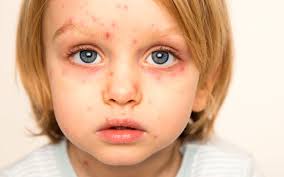 Det er viktig å bestemme over sitt eget liv så lenge det er mulig. Brennkopper Impetigo Vitusapotek