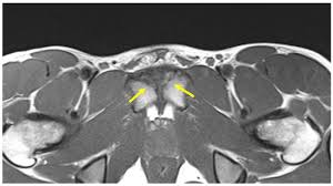 Image result for Pubic Apophysitis
