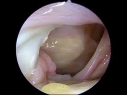 Arthroskopie Gelenkspiegelung Von Knie Hufte Co