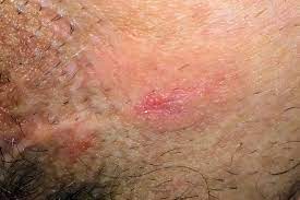 Learn About Extramammary Paget S Disease Empd Myempd Com