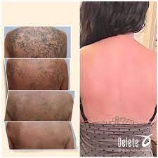 We are here to give you the facts and information you need on. Delete Tattoo Removal Medical Salon Yet Another Success Story From The Fabulous Doctors At Delete It Feels Amazing To Be Able To Erase A Tattoo That Was A Regret