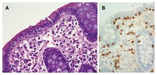 Image result for Microscopic Colitis