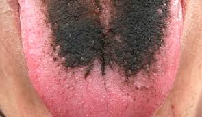 Image result for black hairy tongue symptoms