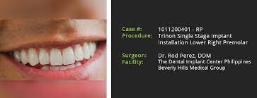 Things to consider before you book. Dental Implants Before And After Dental Implants Cost Or Price Philippines