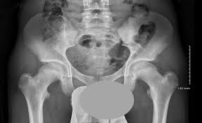 Severe pelvic fractures can be fatal due to internal bleeding or damage to nearby organs, or result in chronic pain and physical disabilities. Pelvic Avulsion Injuries