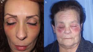 Image result for dermatitis contacta toxica