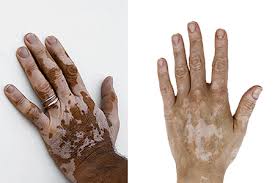 Image result for Vitiligo