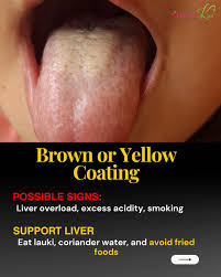 Image result for yellow tongue infection