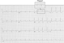 Temuan ekg pertama yang dapat diamati selama infark miokard adalah puncak gelombang t, ditandai dengan gelombang t yang menonjol dengan basis yang relatif sempit. Ekg Part 7 Elevasi Segmen St Dan Penemuan Lain Pada Infark Miokard Difusi Review