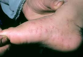 They are most common along the edges of the fingers, toes, palms, and. Pictures Of Childhood Skin Problems Common Rashes And More
