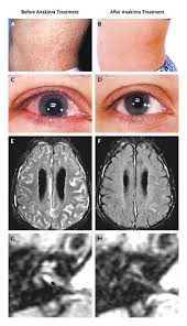 Image result for Multisystem Inflammatory Syndrome