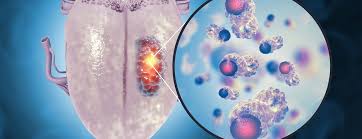 Image result for cancer of tongue