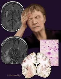 Severe infection, particularly untreated herpes simplex virus (hsv) encephalitis, can cause brain hemorrhagic necrosis. Herpes Simplex Encephalitis Radiographics