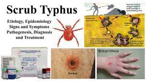 Maybe you would like to learn more about one of these? Scrub Typhus Etiology Epidemiology Symptoms Pathogenesis Diagnosis And Treatment