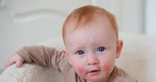 Image result for dermatitis contacta children