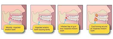 Makeshift Dental Crowns Before And After Cosmetics Dentistofthestars Dentalcrownporcelain Wisdom Tooth Infection Wisdom Teeth Wisdom Teeth Removal