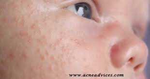 These tips are useful for caring for your baby's skin while he or she has acne: How To Treat Baby Acne Naturally With Breast Milk Is It Working Acne Advices