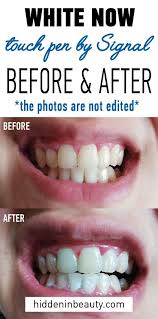 What is the best way to whiten sensitive teeth. Pin On Teeth Whitening