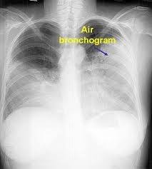 Image result for Air Bronchogram