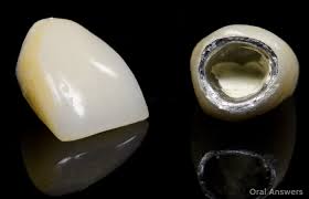 Maybe you would like to learn more about one of these? What You Should Do When A Crown Falls Off Of Your Tooth Oral Answers