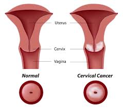 Image result for Cervical Cancer