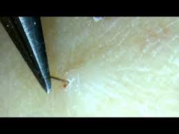 The Root On This Hair Is Soooooo Long Check It Out Youtube Blackheads Popping Ear Pimple Zits Popping