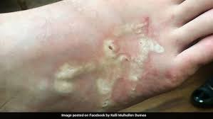 Image result for Hookworm