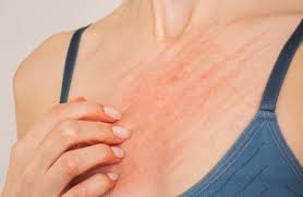 Image result for shingles