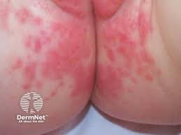 Image result for diaper dermatitis