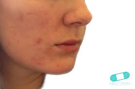 Protuberancias Rojas Que Pican Causas Comunes