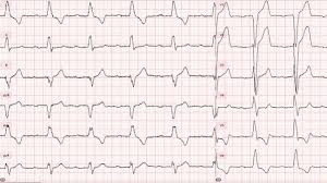 Learn electrocardiography by seeing examples of the various abnormalities. Half Of Tavr Patients Develop Potentially Dangerous Conduction Abnormalities Tctmd Com