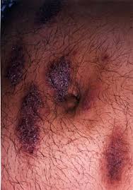 Image result for Atopic eczema atopic dermatitis