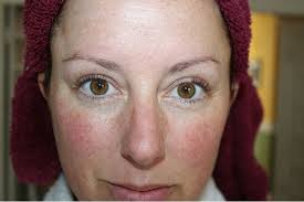 You can experience wheezing, shortness of breath, and coughing fits because of this, says dr. Alcohol Allergy Symptoms Are Not Always Easy To Notice Master Herald