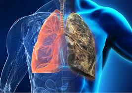 Image result for Lung Cancer