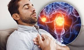 Polyps are a good way to start talking about colon cancer because it is often the earliest stage of cancer. Bowel Cancer Symptoms Signs Of A Tumour Include Heartburn And Stomach Pain Express Co Uk