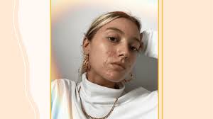 A baker's cyst can often be diagnosed with a physical exam. How To Get Rid Of Cystic Acne According To Skin Experts