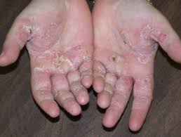 Honey consists of the wonderful humectant properties. Hand Dermatitis Dermnet Nz