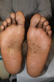 Image result for brown patches on the feet