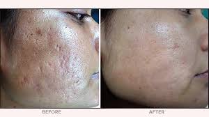 Actinic keratoses (thick or scaly patches; Microdermabrasion Vs Microneedling Cost Results Methods