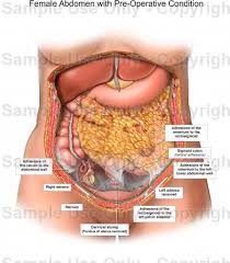 3d video anatomy tutorials on the anatomy of the female reproductive system. Female Abdomen With Pre Operative Condition Medical Illustration Human Anatomy Drawing Anatomy Illustration