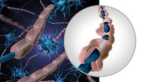 Check spelling or type a new query. Unusual Variant Of Guillain Barre Syndrome Linked To Covid Vaccines Medpage Today