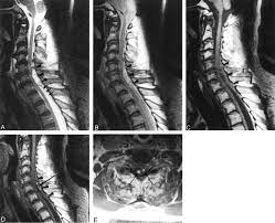 Fig 2 Contrast Enhancement Patterns Of Acute Spinal Epidural Hematomas A Report Of Two Cases American Journal Of Neuroradiology