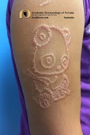 You can overcome this obstacle quite easily however by having a patch test done prior to your permanent tattoo. Contact Dermatitis Henna Tattoos Academic Dermatology Of Nevada