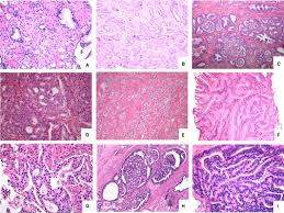 It is also one of the leading causes of cancer death among men. Grading Of Prostate Cancer A Work In Progress Kweldam 2019 Histopathology Wiley Online Library