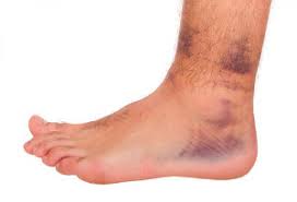 See full list on ehealthwall.com Arthritis Sprains And Strains