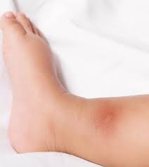 Image result for bedbugs bites