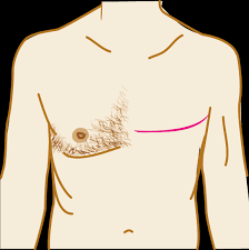 The average size of breast cancer in men when first discovered is about 2.5 cm in diameter. Treatment For Breast Cancer In Men Breast Cancer Now