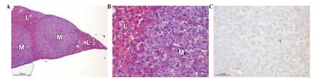 Tumour incident histological finding in more than 5% of tissue retracted. Development Of An Orthotopic Model Of Human Metastatic Prostate Cancer In The Nod Scidg Mouse Mus Musculus Anterior Prostate